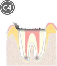 虫歯治療 c4