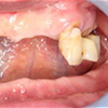 重度歯周病アタッチメント症例