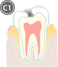 虫歯治療 c1