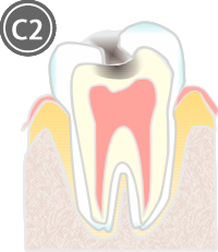 虫歯治療 c2