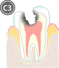 虫歯治療 c3