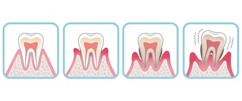 歯周病治療